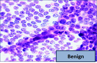 Picture of cells labeled 'Benign.' The cells are roughly round and small.